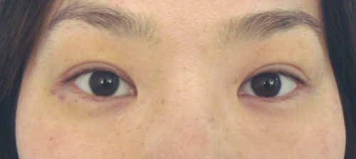 術后一周，腫脹基本消失。