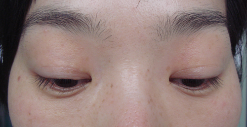 術后1年，顯示手術位置無明顯疤痕，重瞼接近自然狀態。