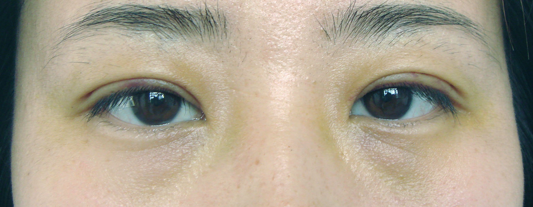 術后1周，雙眼明顯增大有神，重瞼弧度自然、對稱。