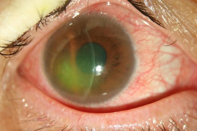   熒光素染色顯示著色區（綠色）為角膜上皮糜爛